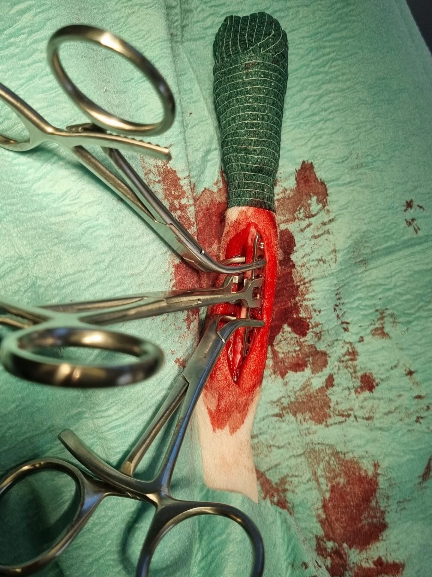 653707834_1384042303720672_7154452377938638308_n Leg fracture